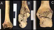 Lesões ósseas causadas por artrite no esqueleto encontrado no Egito - Divulgação/M. Mant, et al