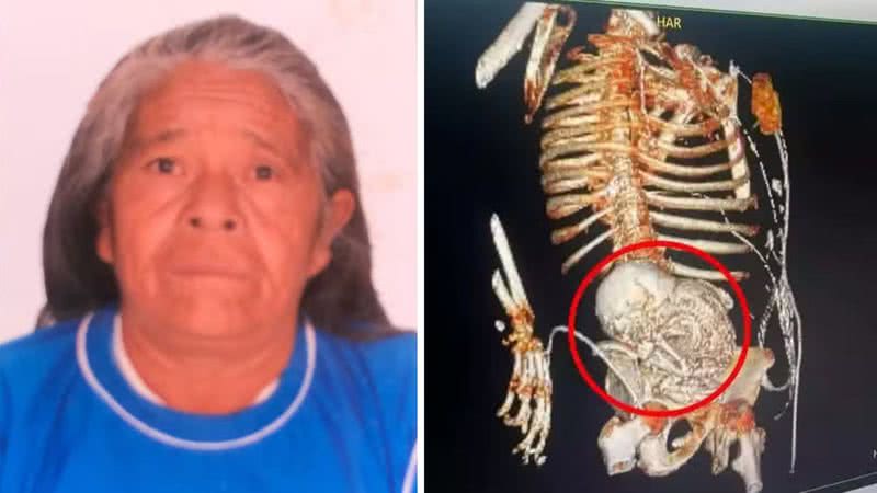 A paciente Daniela Almeida Vera, que descobriu feto calcificado em seu ventre - Divulgação