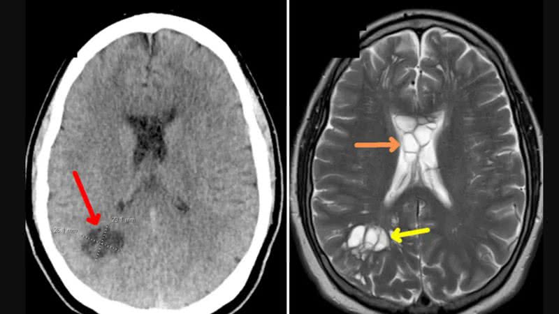 Imagens de exames cerebrais do homem - Divulgação/ American Journal of Case Reports