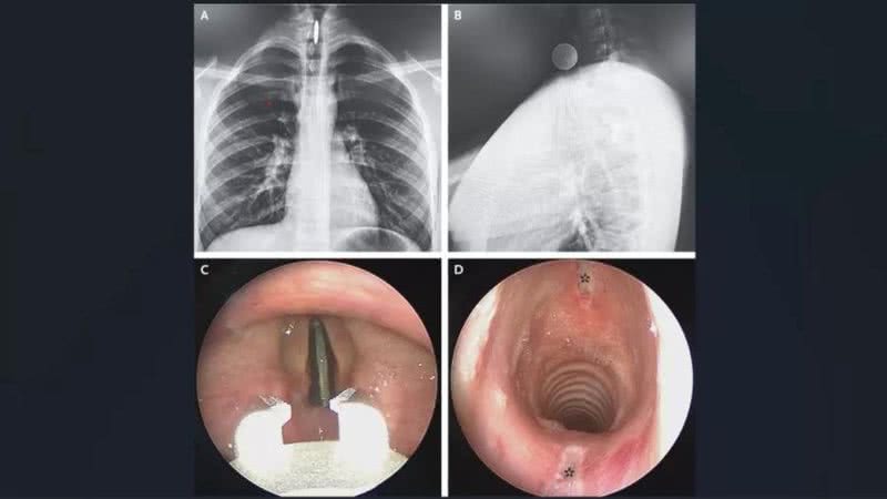 Moeda de 25 centavos foi parar nas cordas vocais do adolescente - Divulgação/The New England Journal of Medicine