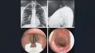 Moeda de 25 centavos foi parar nas cordas vocais do adolescente - Divulgação/The New England Journal of Medicine