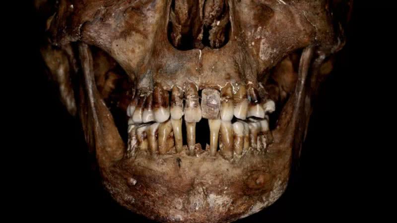 Dentes de Anne d'Alègre, a mulher com o aparelho de ouro - Divulgação/Journal of Archaeological Science: Reports/Rozenn Colleter