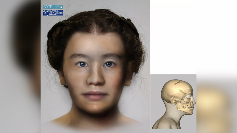 Reconstrução facial da jovem norueguesa que contraiu infecção de Salmonella enterica - Divulgação / Stian Suppersberger Hamre et.al