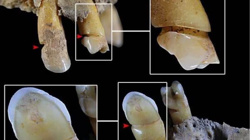 Evidências peculiares encontradas nos dentes - Divulgação - Ángel Rubio Salvador