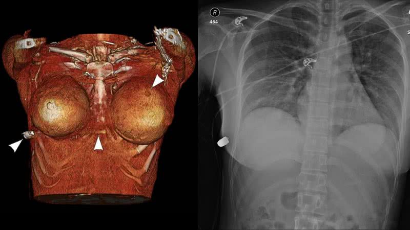 Os exames digitalizados analisando a trajetória da bala no silicone - McEvenue et al. / Plastic Surgery Case Studies