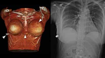 Os exames digitalizados analisando a trajetória da bala no silicone - McEvenue et al. / Plastic Surgery Case Studies