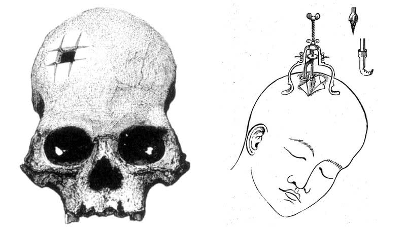 Ilustração demonstra técnica de trepanação - Wikimedia Commons