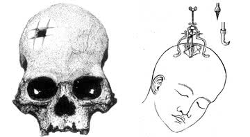 Ilustração demonstra técnica de trepanação - Wikimedia Commons