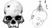 Ilustração demonstra técnica de trepanação - Wikimedia Commons