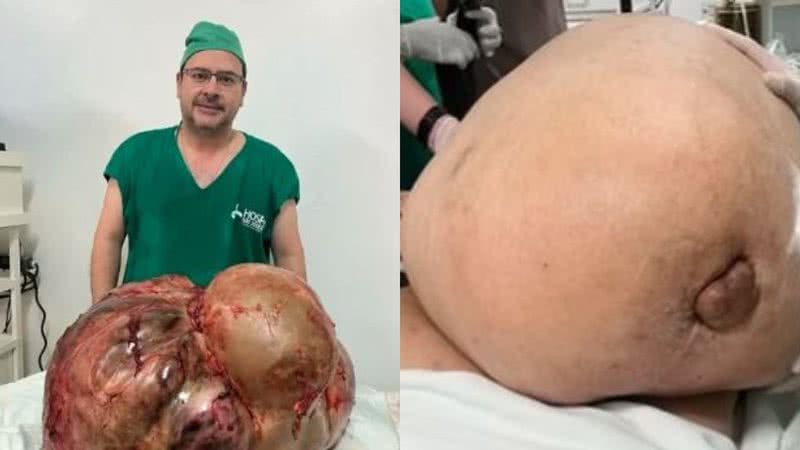 Á esquerda imagem de médico com o tumor e à direita tumor no momento da cirurgia - Reprodução/Arquivo pessoal / Reprodução/Vídeo/UOL