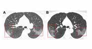 Imagem do antes e depois dos pulmões do paciente do Coronavírus - Junqiang Lei, Junfeng Li, Xun Li, and Xiaolong Qi