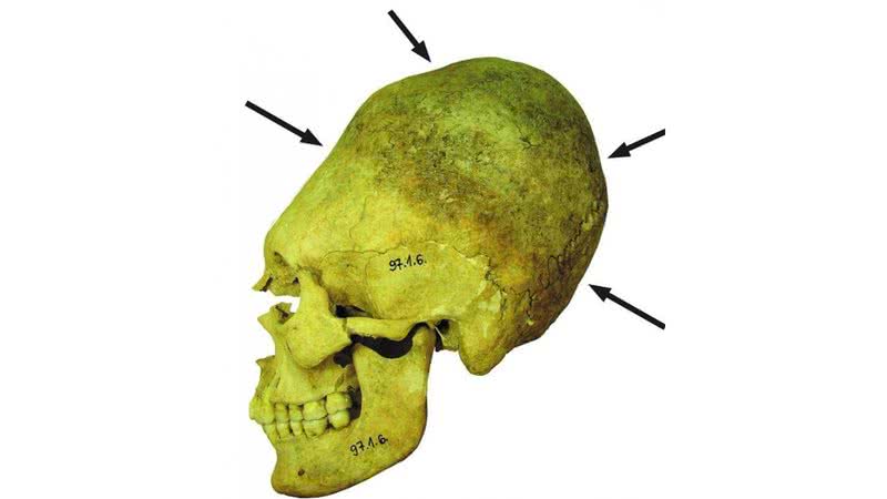 Crânio de mulher adulta deformado - Divulgação
