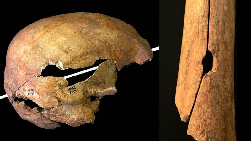 Duas perfurações identificadas pela equipe de pesquisa; uma no crânio, outra no fêmur - Oliver Creighton / Universidade de Exeter