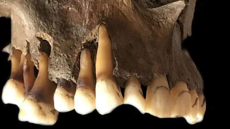 Uma amostra de DNA com herpes labial do século 17 - Universidade de Cambridge