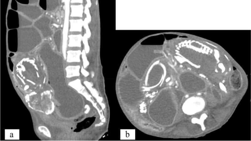 Imagens de raios X do feto calcificado no abdômen da mulher - Divulgação/Wassem Sous et. al/BMC Women's Health