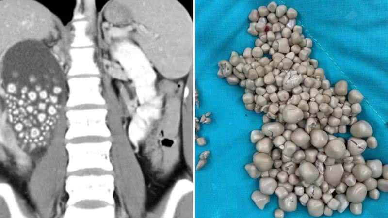 As pedras encontradas no rim da jovem - Reprodução/Hospital Chi Mei