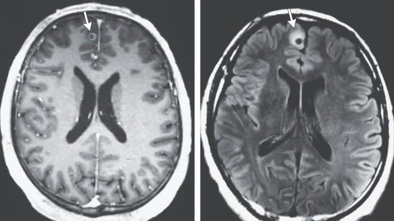 Imagem de ressonância magnética da cabeça do paciente - Divulgação / Massachusetts Medical Society