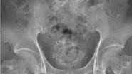 Raio-x revelou que havia uma corda presa na bexiga do paciente - Divulgação / Urology Case Reports