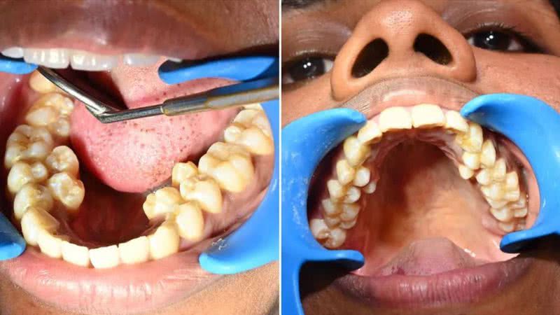 Kalpana Balan possui seis dentes a mais do que a maioria das pessoas - Divulgação/Guinness World Records