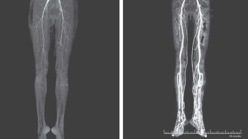 Raio-x da paciente antes e depois do tratamento - Divulgação/The New England Journal of Medicine