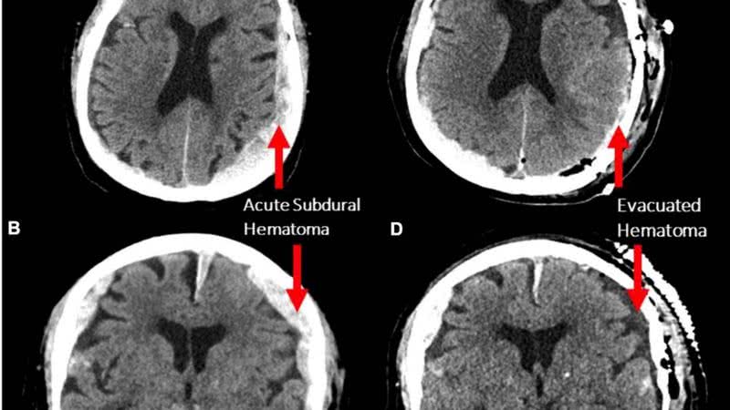 Tomografia computadorizada realizada para o estudo - Divulgação/Frontiers in Aging Neuroscience