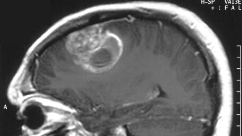 Imagem ilustrativa de raio-x de paciente com glioblastoma - Christaras A via Wikimedia Commons