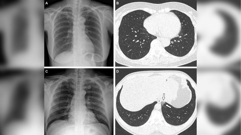 Primeiro caso de pneumonia de mulher de 65 anos que contraiu covid completamente vacinada; segunda imagem de homem depois de 1 dose de vacina - Divulgação/Sociedade Radiológica da América do Norte