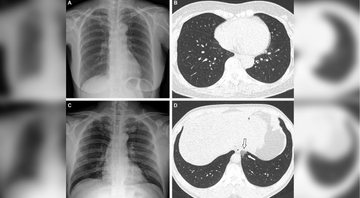 Primeiro caso de pneumonia de mulher de 65 anos que contraiu covid completamente vacinada; segunda imagem de homem depois de 1 dose de vacina - Divulgação/Sociedade Radiológica da América do Norte