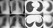 Primeiro caso de pneumonia de mulher de 65 anos que contraiu covid completamente vacinada; segunda imagem de homem depois de 1 dose de vacina - Divulgação/Sociedade Radiológica da América do Norte