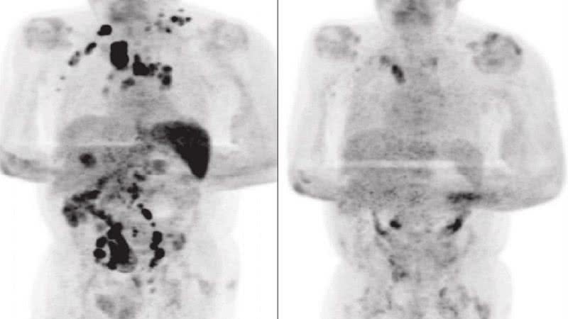 Exame de tomografia do paciente que mostra a remissão da doença - Divulgação/ British Journal of Haematology