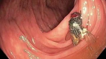 A mosca no intestino do paciente - The American Journal of Gastroenterology