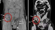 Exames de imagem mostrando a situação do homem - Divulgação/ BMJ Journals