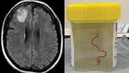 Imagem da ressonânica feita no cérebro da paciente e do o verme retirado do cérebro - Divulgação/Emerging Infectious Diseases
