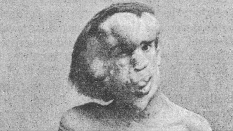 A face de Joseph Merrick - Wikimedia Commons