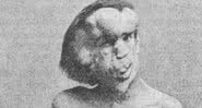 A face de Joseph Merrick - Wikimedia Commons