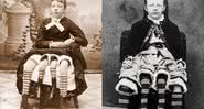 Josephine Myrtle Corbin, a mulher de quatro pernas - Divulgação