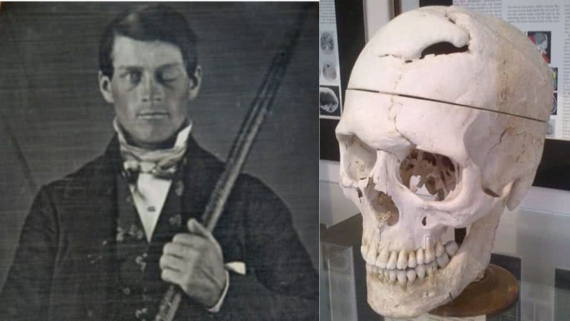 Phineas P. Gage e como ficou seu crânio após o acidente - Wikimidia Commons