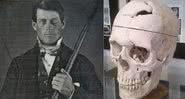 Phineas P. Gage e como ficou seu crânio após o acidente - Wikimidia Commons