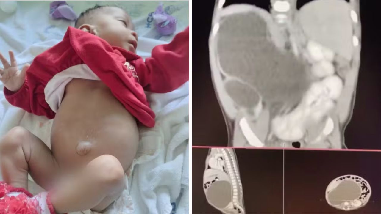 Em Goiás, menina surpreende equipe médica ao nascer com quatro rins