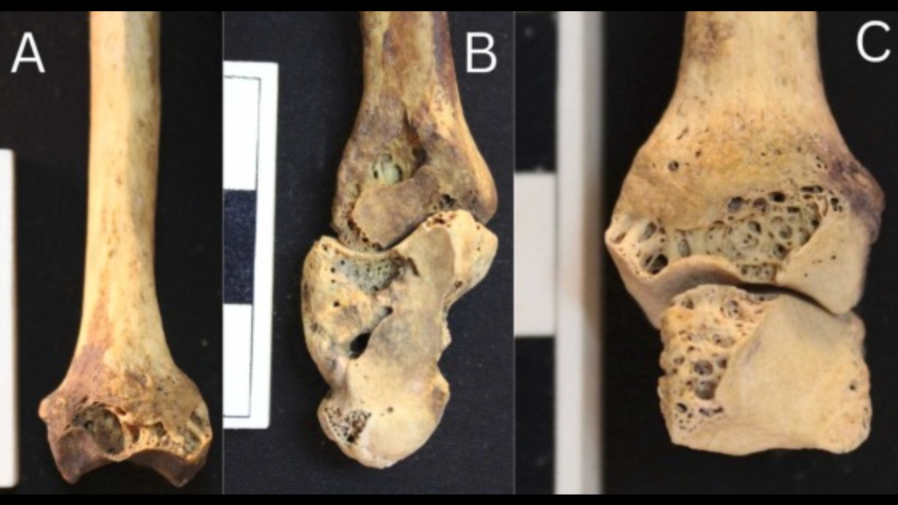 Enterro de 3.500 anos revela um dos primeiros casos de doença óssea comum hoje