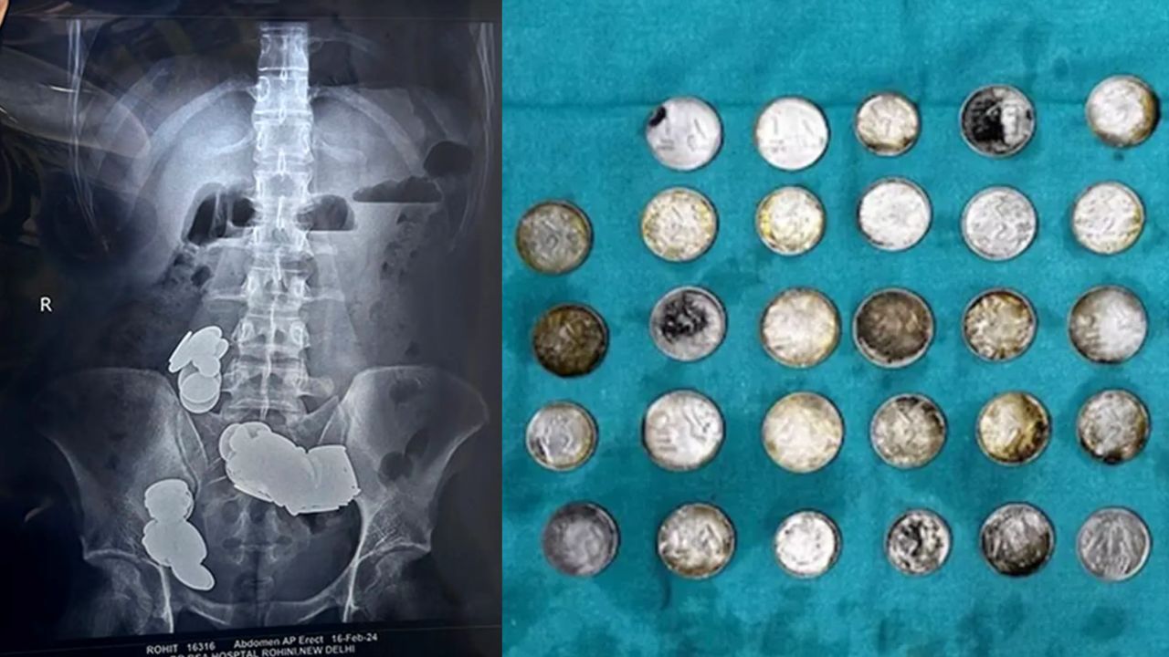 Halterofilista engole 39 moedas na Índia na tentativa de incluir ‘zinco’ na dieta