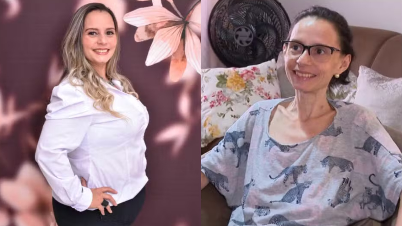Mulher desenvolve anemia após bariátrica e faz cirurgia reversa