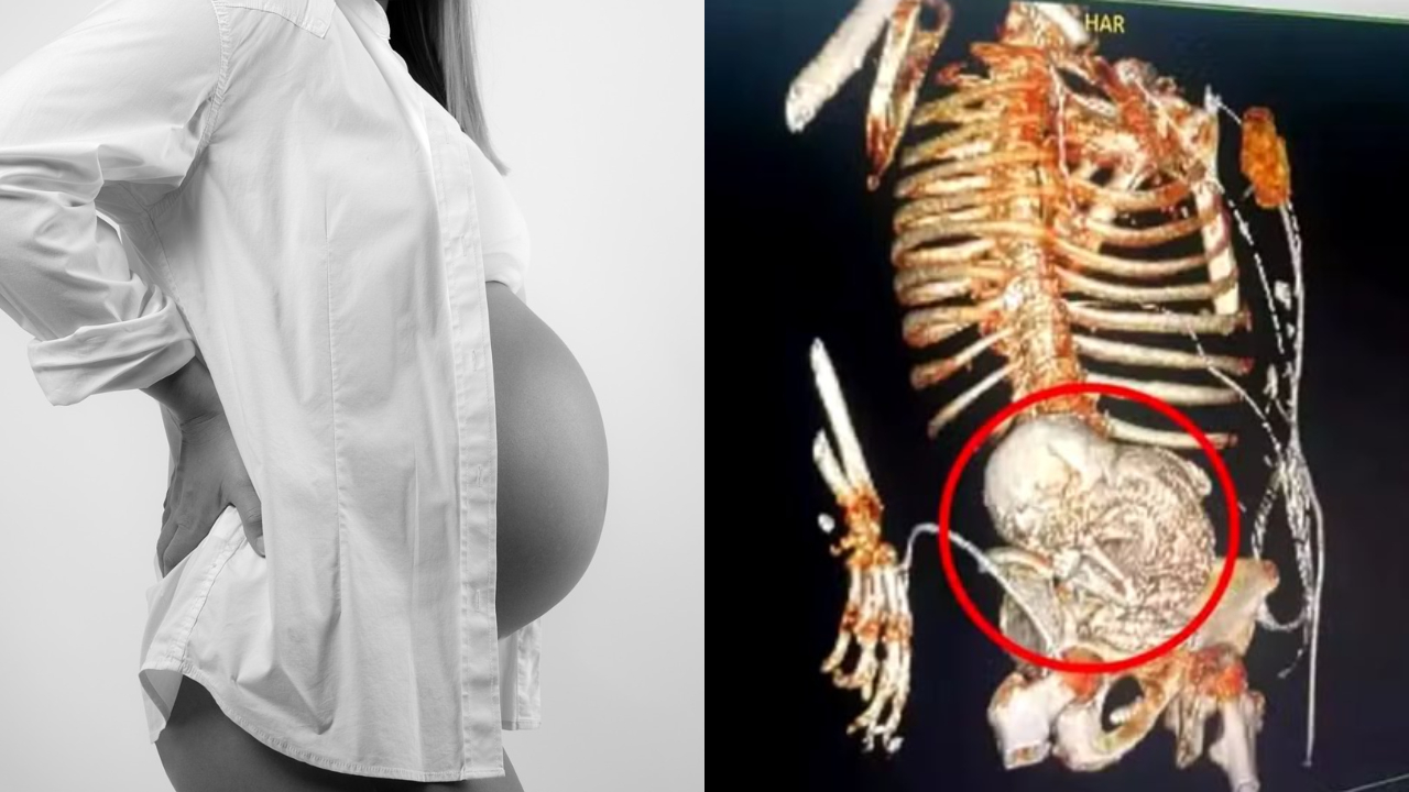 Idosa de 81 anos descobre ‘bebê de pedra’ dentro de si por mais de 5 décadas