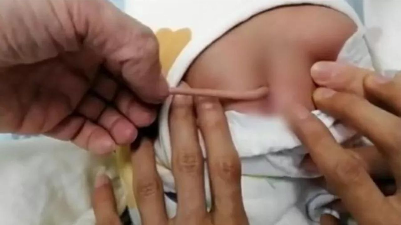 Hospital na China registra nascimento de bebê com ‘cauda’ de 10 centímetros