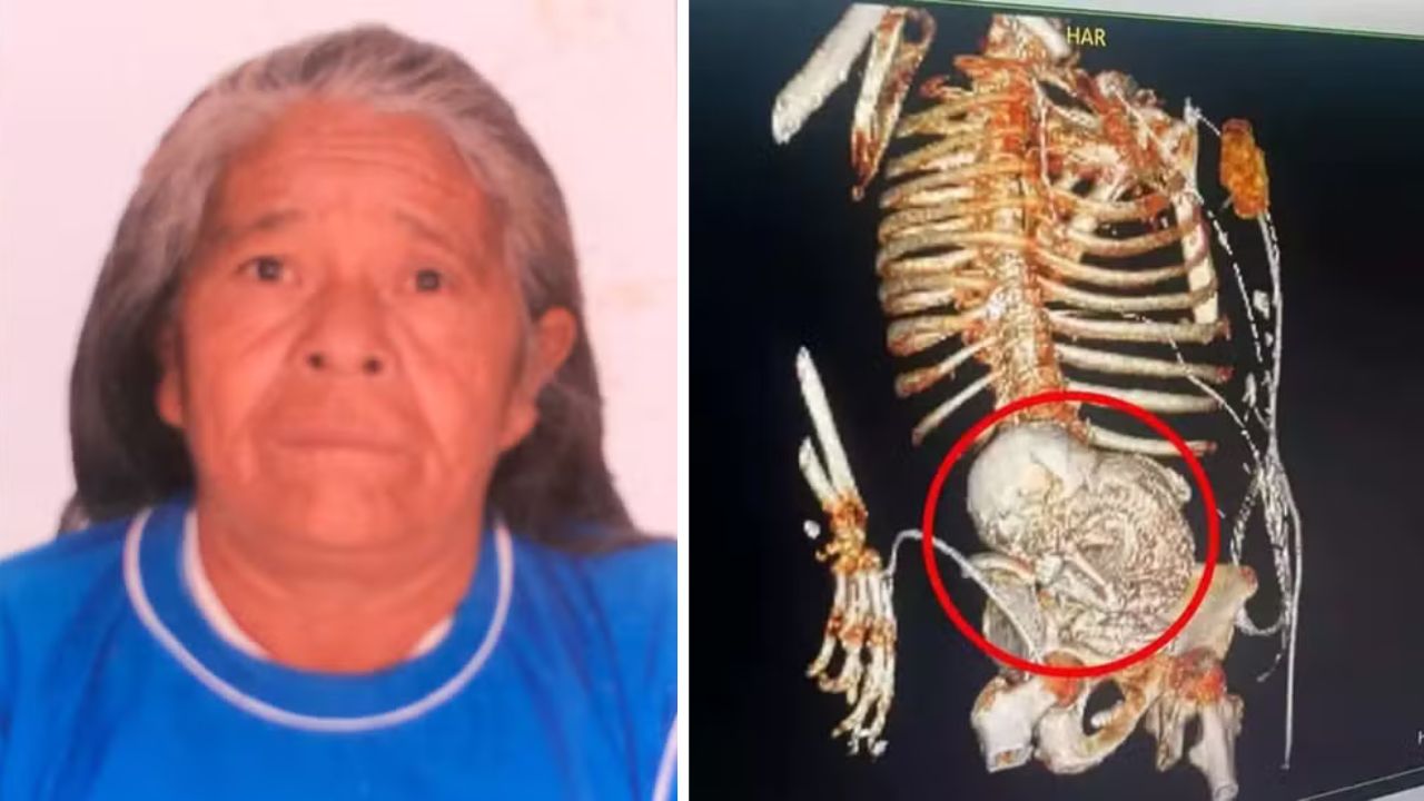 Idosa com feto calcificado há mais de 5 décadas tinha medo de ir ao médico