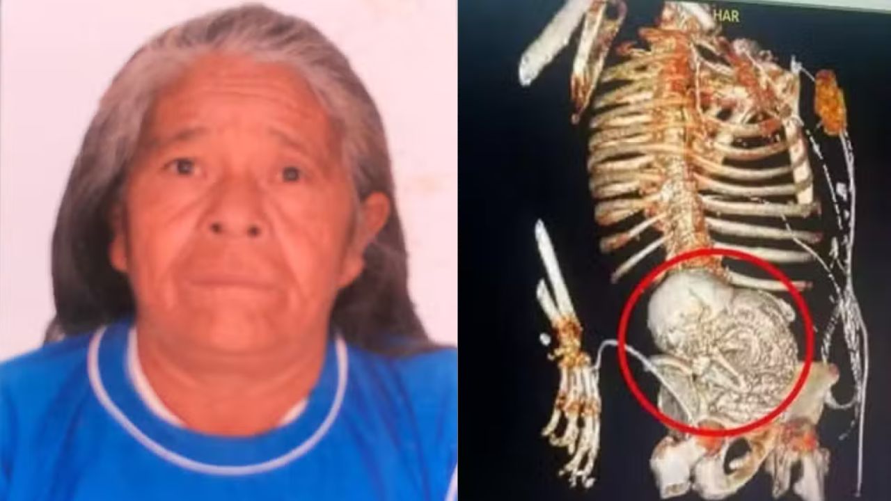 Família autoriza estudo com feto calcificado retirado de barriga de idosa