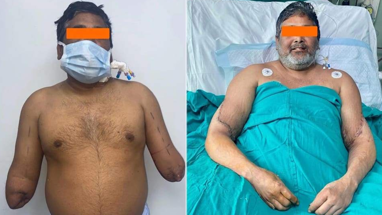 Índia: Pintor passou por primeiro transplante bilateral de mãos