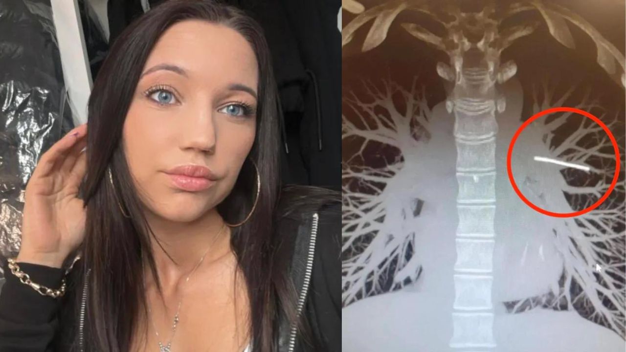 Britânica descobre implante hormonal em seu pulmão
