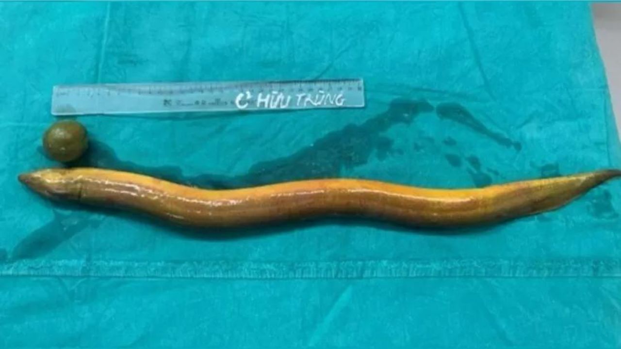 Homem passa por cirurgia e perde parte do cólon após inserir enguia no ânus