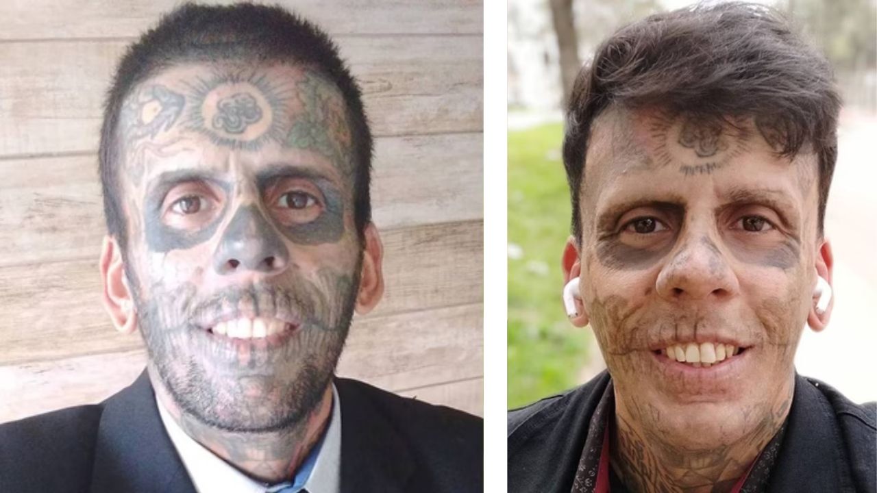 Homem mais tatuado do Brasil inicia processo de remoção das tattoos
